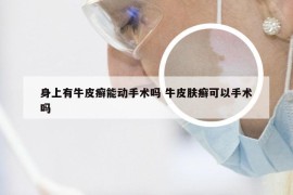 身上有牛皮癣能动手术吗 牛皮肤癣可以手术吗