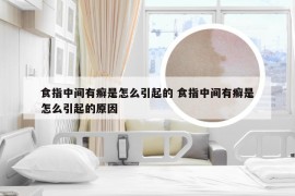 食指中间有癣是怎么引起的 食指中间有癣是怎么引起的原因