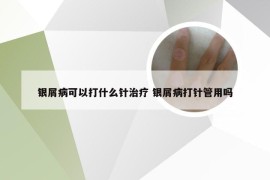 银屑病可以打什么针治疗 银屑病打针管用吗