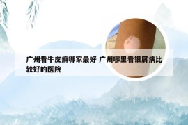 广州看牛皮癣哪家最好 广州哪里看银屑病比较好的医院