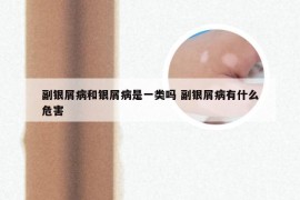 副银屑病和银屑病是一类吗 副银屑病有什么危害