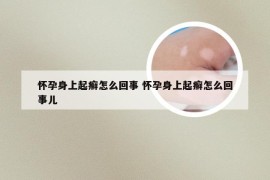 怀孕身上起癣怎么回事 怀孕身上起癣怎么回事儿