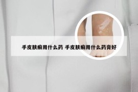 手皮肤癣用什么药 手皮肤癣用什么药膏好