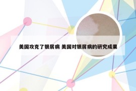 美国攻克了银屑病 美国对银屑病的研究成果