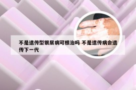 不是遗传型银屑病可根治吗 不是遗传病会遗传下一代