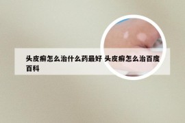 头皮癣怎么治什么药最好 头皮癣怎么治百度百科