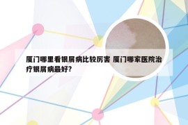厦门哪里看银屑病比较厉害 厦门哪家医院治疗银屑病最好?