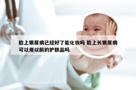 脸上银屑病已经好了能化妆吗 脸上长银屑病可以用以前的护肤品吗