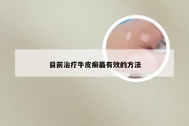 目前治疗牛皮癣最有效的方法