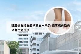 银屑病有没有起病只有一块的 银屑病有没有只有一处皮损
