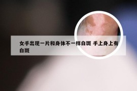 女手出现一片和身体不一样白斑 手上身上有白斑