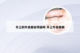 手上的牛皮癣会传染吗 手上牛皮肤癣
