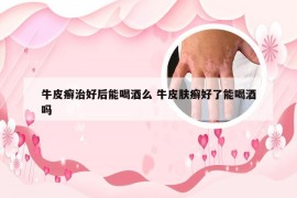 牛皮癣治好后能喝酒么 牛皮肤癣好了能喝酒吗