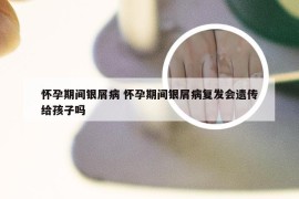 怀孕期间银屑病 怀孕期间银屑病复发会遗传给孩子吗