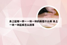 身上起哪一种一一块一块的癣是什么癣 身上一块一块起癣怎么回事