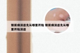 银屑病消退先从哪里开始 银屑病消退先从哪里开始消退