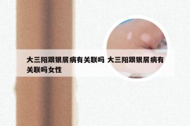 大三阳跟银屑病有关联吗 大三阳跟银屑病有关联吗女性