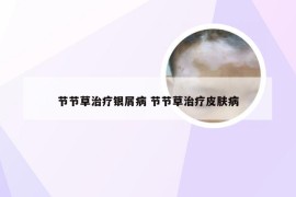 节节草治疗银屑病 节节草治疗皮肤病
