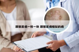 跟银屑病一样一块 跟银屑病相似的病