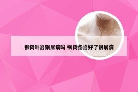 柳树叶治银屑病吗 柳树条治好了银屑病