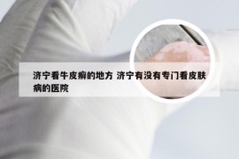 济宁看牛皮癣的地方 济宁有没有专门看皮肤病的医院