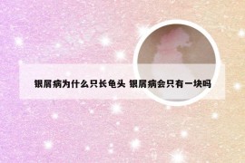 银屑病为什么只长龟头 银屑病会只有一块吗