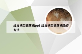 红皮病型银屑病ppt 红皮病型银屑病治疗方法