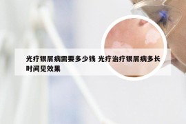 光疗银屑病需要多少钱 光疗治疗银屑病多长时间见效果