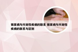 银屑病与代谢性疾病的联系 银屑病与代谢性疾病的联系与区别
