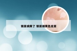 银屑病黄了 银屑病黄色皮屑