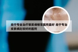 南宁专业治疗银屑病哪家医院最好 南宁专治皮肤病比较好的医院