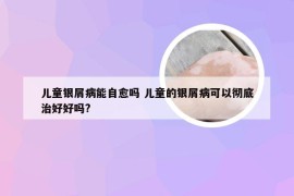 儿童银屑病能自愈吗 儿童的银屑病可以彻底治好好吗?