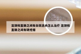 宫颈和直肠之间有白斑息肉怎么治疗 宫颈和直肠之间有硬疙瘩
