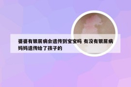 婆婆有银屑病会遗传到宝宝吗 有没有银屑病妈妈遗传给了孩子的