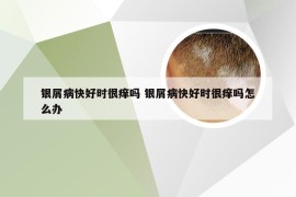 银屑病快好时很痒吗 银屑病快好时很痒吗怎么办