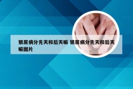 银屑病分先天和后天嘛 银屑病分先天和后天嘛图片