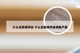 什么皮肤病传染 什么皮肤病传染病最严重