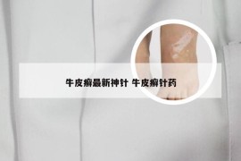 牛皮癣最新神针 牛皮癣针药