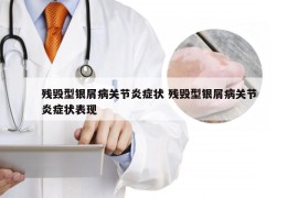 残毁型银屑病关节炎症状 残毁型银屑病关节炎症状表现