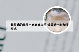 银屑病的鳞屑一定会出血吗 银屑病一定有鳞屑吗