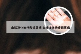 血浆净化治疗和银屑病 血液净化治疗银屑病