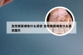 急性银屑病有什么症状 急性银屑病有什么症状图片