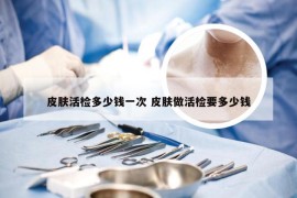 皮肤活检多少钱一次 皮肤做活检要多少钱