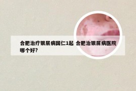 合肥治疗银屑病国仁1起 合肥治银屑病医院哪个好?