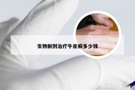 生物制剂治疗牛皮癣多少钱