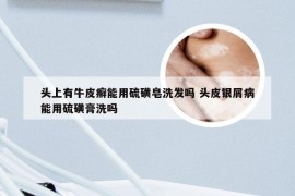 头上有牛皮癣能用硫磺皂洗发吗 头皮银屑病能用硫磺膏洗吗