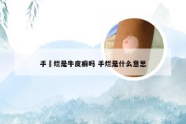 手劽烂是牛皮癣吗 手烂是什么意思