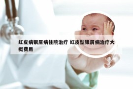 红皮病银屑病住院治疗 红皮型银屑病治疗大概费用