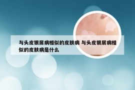 与头皮银屑病相似的皮肤病 与头皮银屑病相似的皮肤病是什么