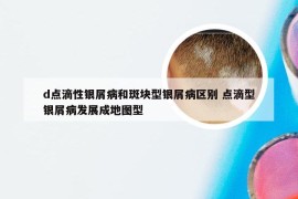 d点滴性银屑病和斑块型银屑病区别 点滴型银屑病发展成地图型
